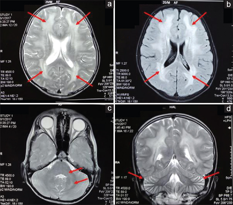 Axial T2 (a) and fluid-attenuated inversion recovery (b) images showing hyperintensities (arrows) in bilateral frontal and parietal white matter with typical sparing of subcortical “U” fibers. Axial T2 image showing hyperintensities (arrows) in bilateral dentate nuclei, middle cerebellar peduncles, and dorsal pons (c). T2 coronal section showing prominent cerebellar folia (arrows) – suggestive of cerebellar atrophy (d)