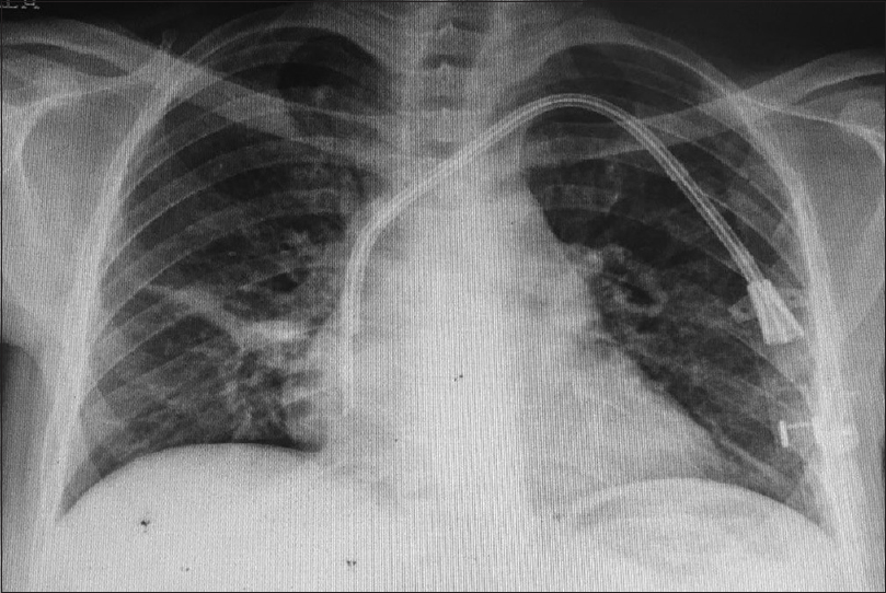 X - ray chest showing tip of TVC in right atrium and bilateral diffuse infiltrates