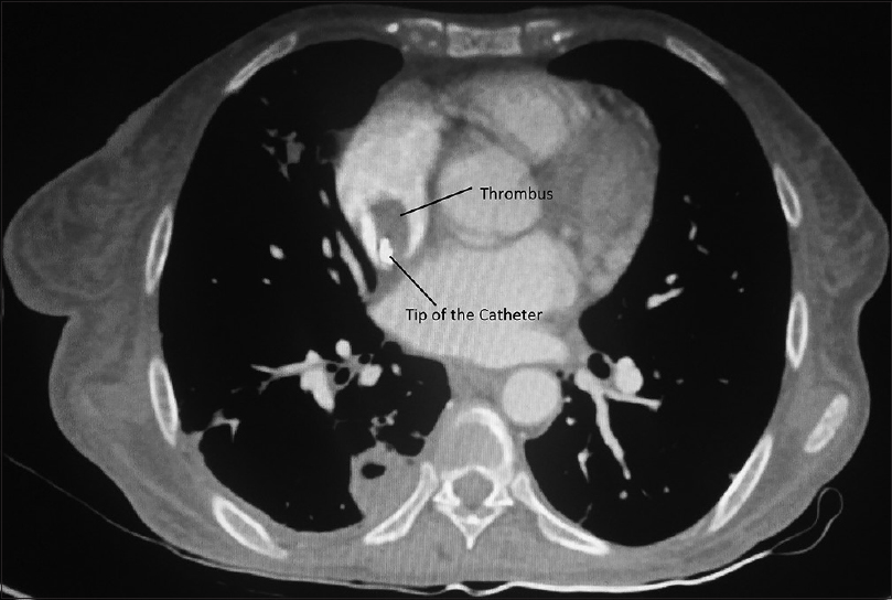 Contrast-enhanced computed tomography thorax shows filling defect adjacent to the catheter tip in right atrium