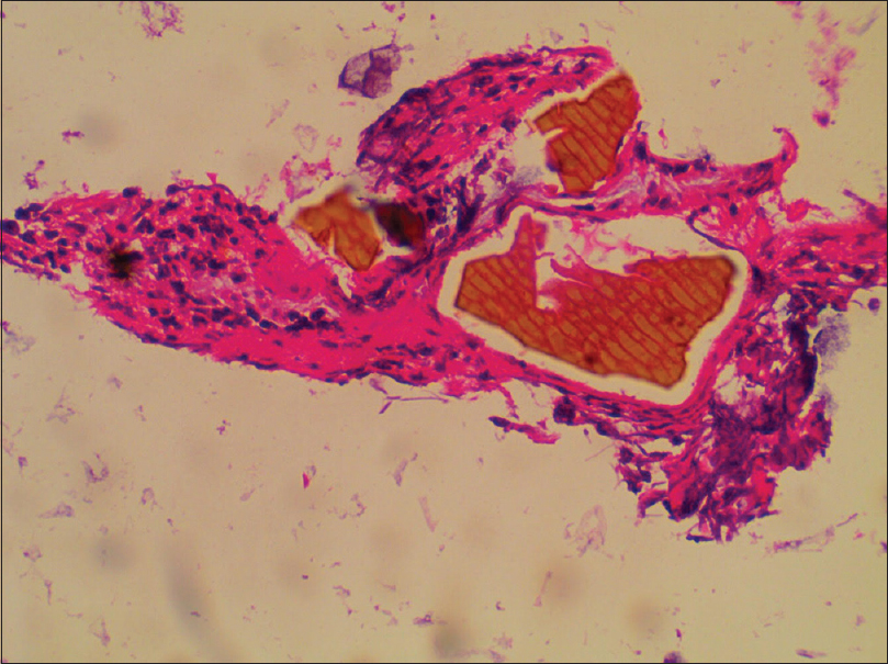 Sevelamer crystals embedded in the colonic mucosa
