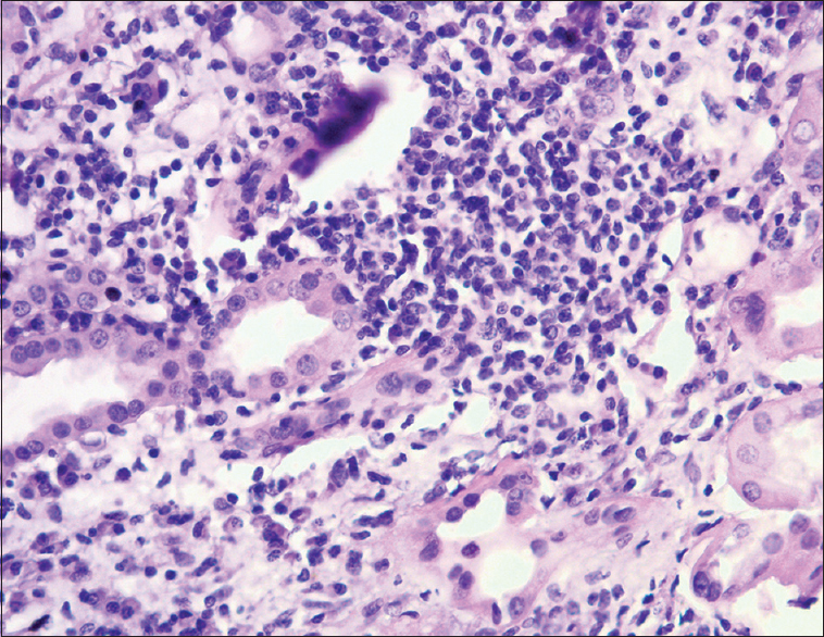 Dense peritubular, mononuclear interstitial infiltration (Periodic acid–Schiff coloration × 100)