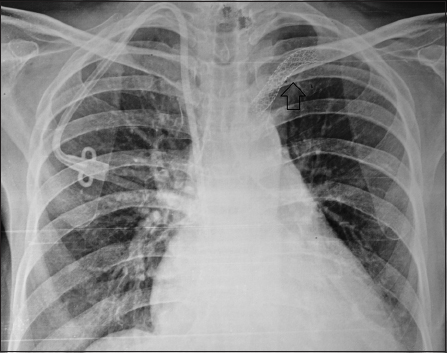 Chest X ray showing the position of the stent graft (arrow). Also seen is a right IJV tunneled catheter which was placed on a later date