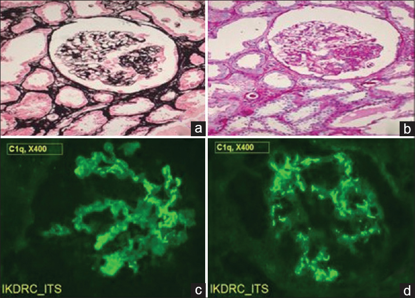 (a) (Jones methenamine silver, ×100) and (b) (Periodic acid–Schiff, ×100) showing focal segmental mesangial sclerosis with synechiae formation. (c and d) (Immunofluorescence, ×400) shows fine granular staining with antihuman C1q in mesangial regions of glomeruli
