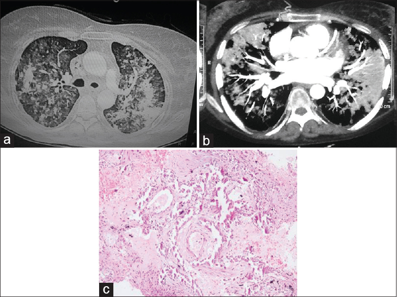 (a and b) High-resolution computed tomography of the chest revealed multiple hyperdense airspace infiltrates involving bilateral lung fields and enlarged mediastinal lymph nodes with calcification. (c) Lung biopsy showing of marked thickening of alveolar septa along with fibrosis and extensive calcification (H and E, ×200)