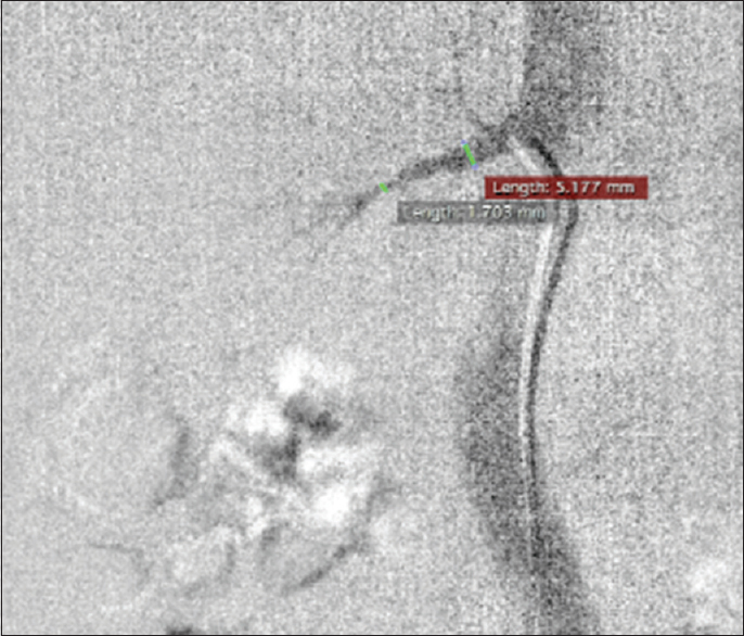 The visualization right renal artery (Before IAHF*). *Intra-arterial heparin flushing