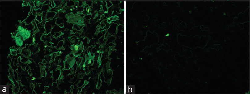 (a) Strong positive staining for Kappa light chain seen in the tubular basement membranes and in the fractured cast. (b) There is no staining for Lambda light chain around the tubules or the casts