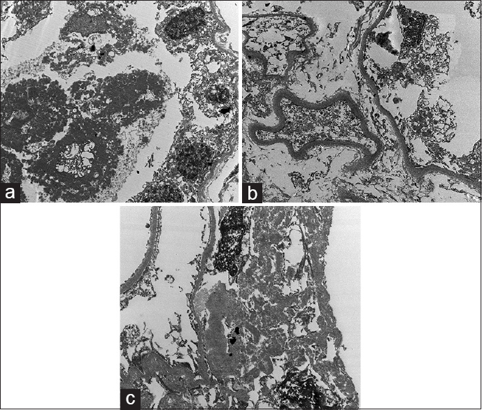 (a) Deeply osmiophilic coarse granular casts within tubules. (b) Powdery deposits along tubular basement membrane. (c) Aggregates of pale non branching fibrils measuring 8 to 11 nm in diameter in the hilum of the glomerulus