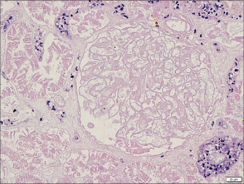 Diffuse area of cortical coagulative necrosis of glomeruli and tubules. Arterioles show no evidence of thrombus or vasculitis. (H and E, original magnification ×40)