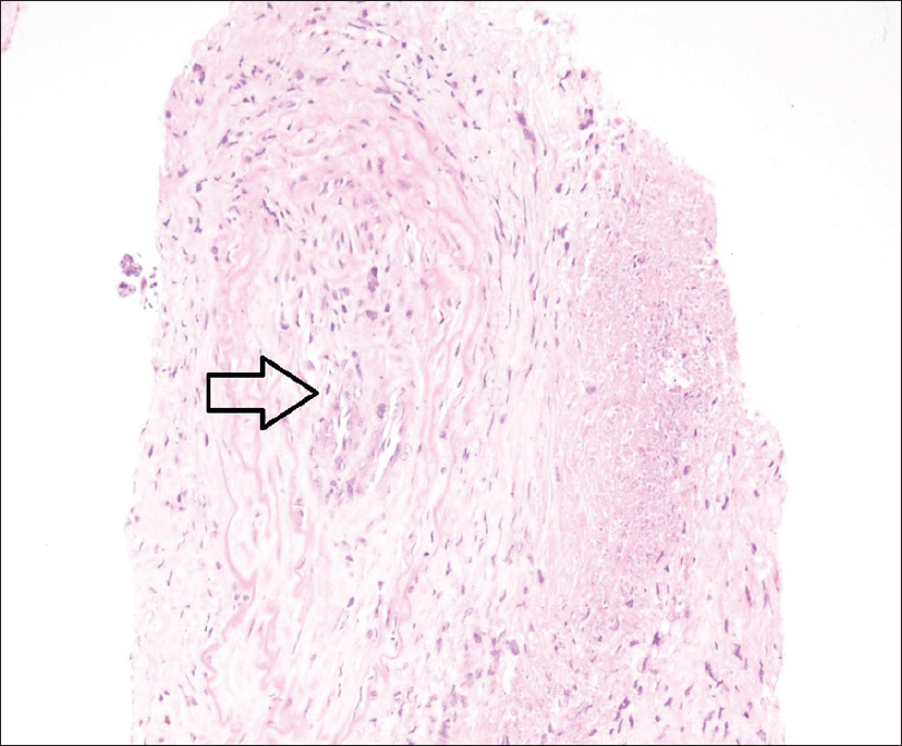 High power photomicrograph of renal biopsy showing medium sized artery with recanalised thrombus in the lumen and infiltrating polymorphs (arrow)