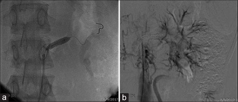 Case 2: CT angiogram: (a) stenosed renal artery with guidewire through it and (b) revascularized kidney after dilatation