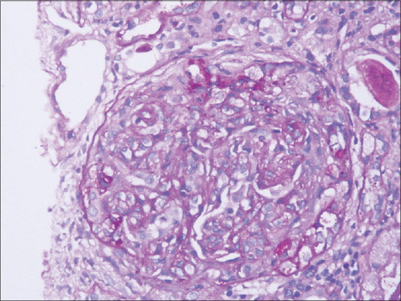 PAS, 40× view shows single glomerulus with crescent and underlying tuft showing mesangial and endocapillary hypercellularity