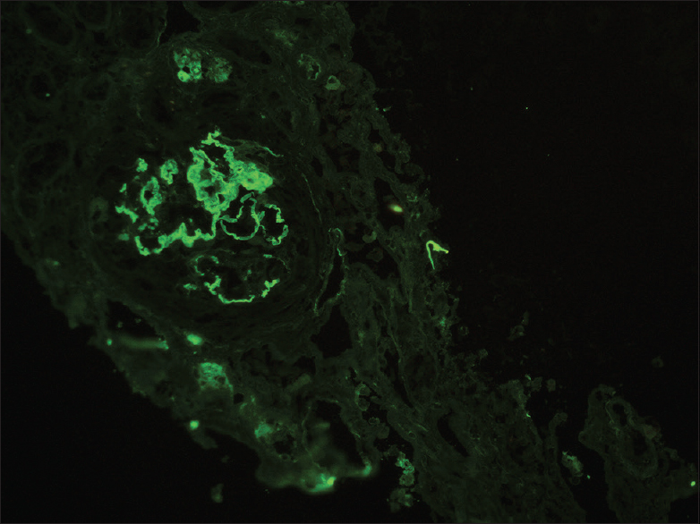 Immunofluorescence with IgG antibody shows linear IgG staining along glomerular capillary basement membranes with 3–4+ intensity