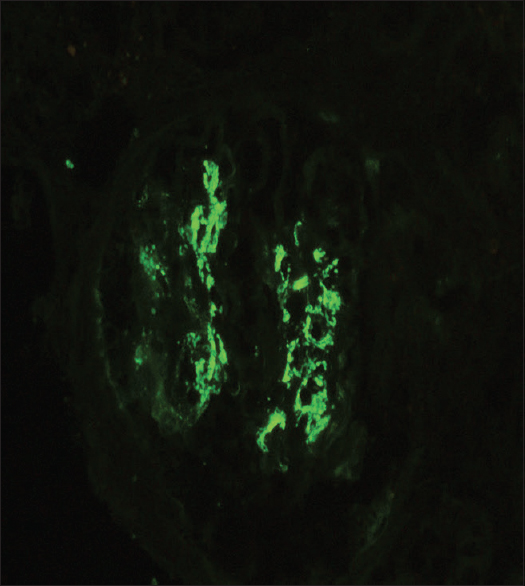 Immunofluorescence with IgA antibody shows granular staining in mesangium with 3–4+ intensity