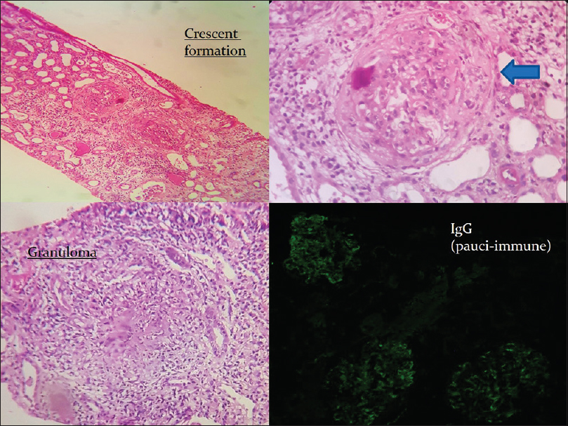 Case of pauci-immune crescentic glomerulonephritis