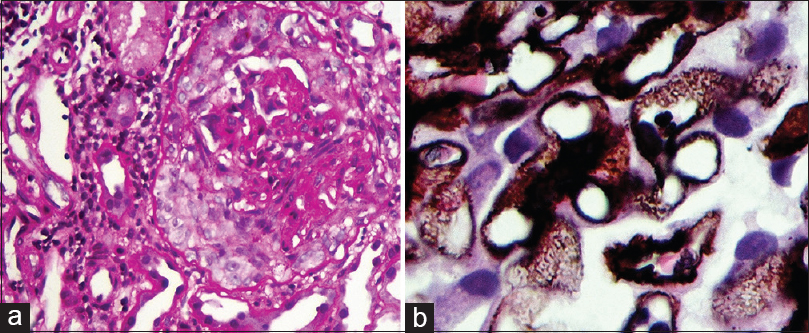 (a) Cellular crescent encircles and compresses the capillary tuft (Periodic Acid Schiff × 400 magnification). (b) PAS-silver stain showing spike lesions in the GBM