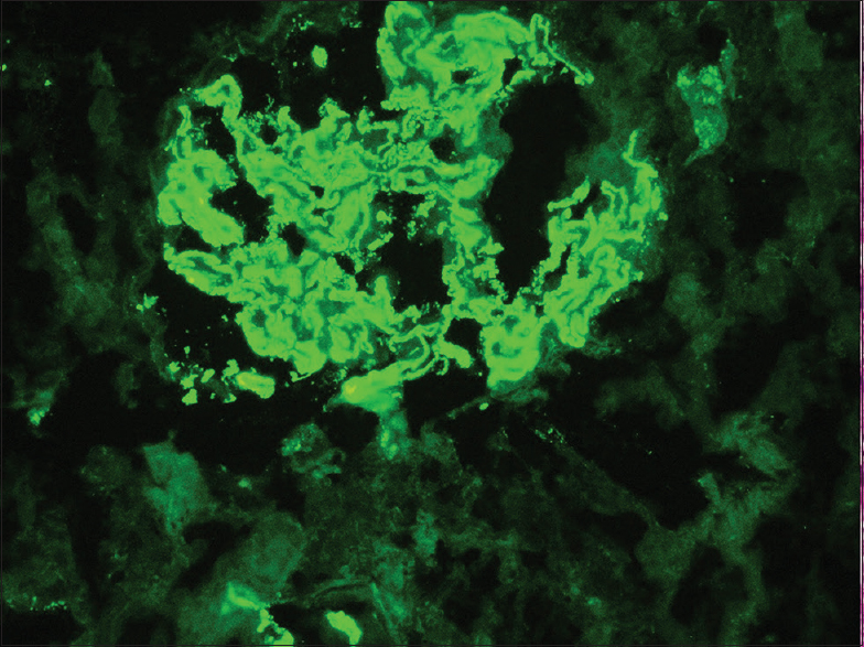 Immunofluorescence showing intense granular staining for IgG antisera along the capillary loops