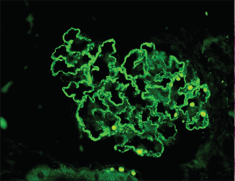 Immunofluorescence showing intense staining for PLA2R