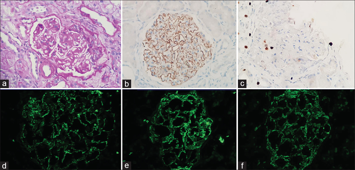 (a) PAS-stained paraffin section showing membranous nephropathy with overlying podocyte hyperplasia indicating collapse, (b) PLA2R immunostain showing fine granular positivity along the capillary wall, (c) Ki67 immunostain showing occasional positivity on the podocytes, and (d-f) direct immunofluorescence showing fine granular capillary wall positivity from IgG, kappa, and lambda, respectively (400× magnification)
