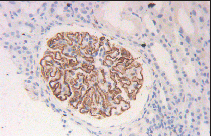 Renal biopsy shows uniform staining of glomerular capillary walls with PLA2R antigen