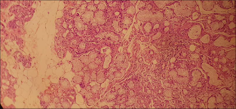 Salivary gland tissue with peri-acinar lymphocytic cell infiltration suggestive of Sjogren's syndrome