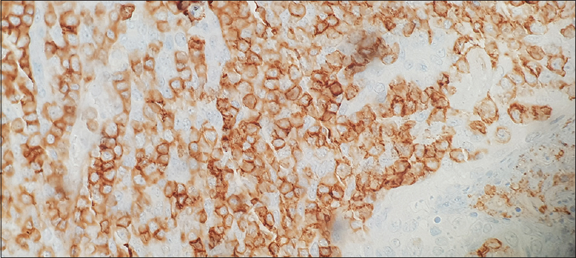 Salivary gland shows CD 45 positive lymphocytic cell infiltrates suggestive of Sjogren's syndrome