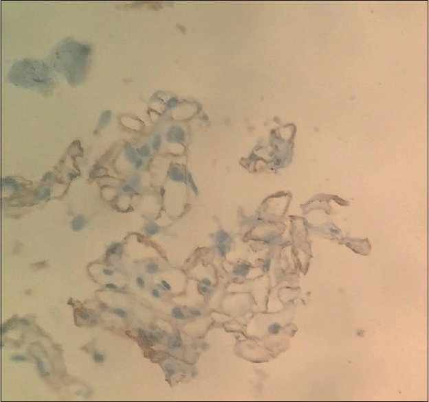 Positive IgG4 staining along glomerular capillary wall suggestive of Primary membranous nephropathy