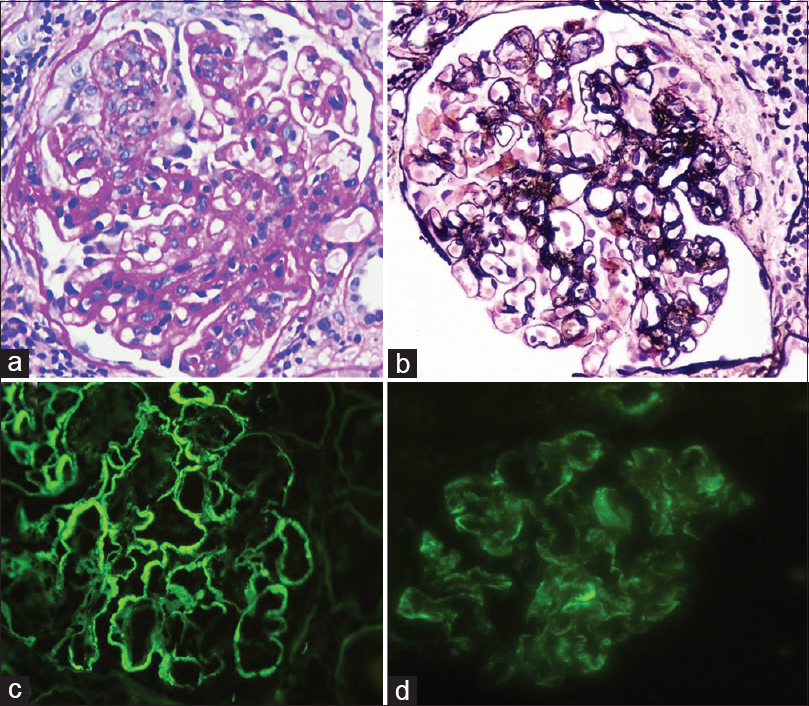 Glomerulus showing an MPGN pattern glomerulonephritis with mesangial and endocapillary proliferation and segmental duplication of the basement membrane (Panel a – PAS, ×400; Panel b - Jones silver, ×400). Direct immunofluorescence stains showing significant peripheral deposits of IgG (Panel c, ×400) and C3c (Panel d, ×400)