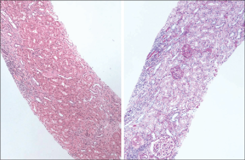 A small focus of tubular atrophy and interstitial fibrosis on the left side (×100)