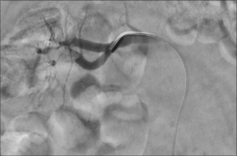 Renal angiography before right renal artery thrombolysis