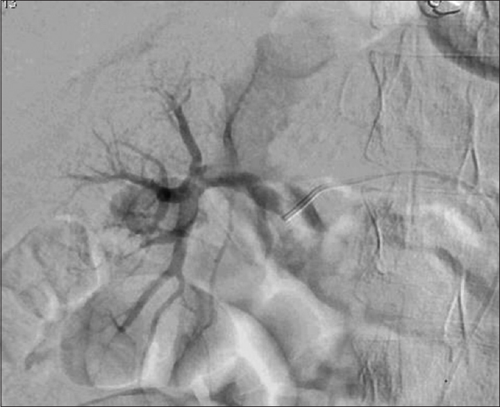 Renal angiography after right renal artery thrombolysis