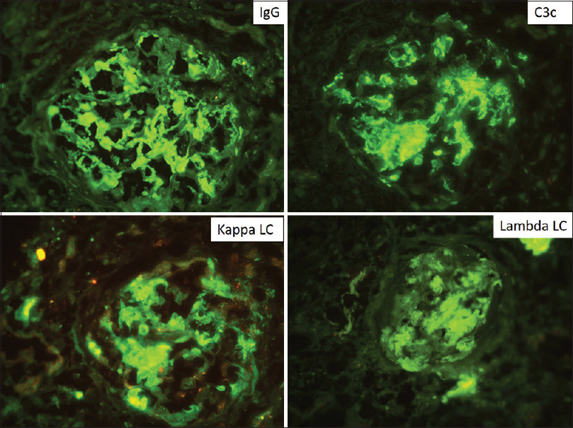 Composite picture of direct immunofluorescence showing strong positivity in a peripheral and mesangial pattern for IgG, C3c, κ and λ light chains in equal intensity with no evidence of light chain restriction