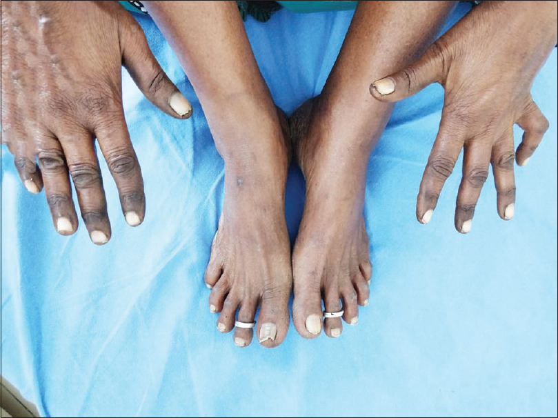 Acral pigmentation involving dorsum of hands, knuckles, and feet