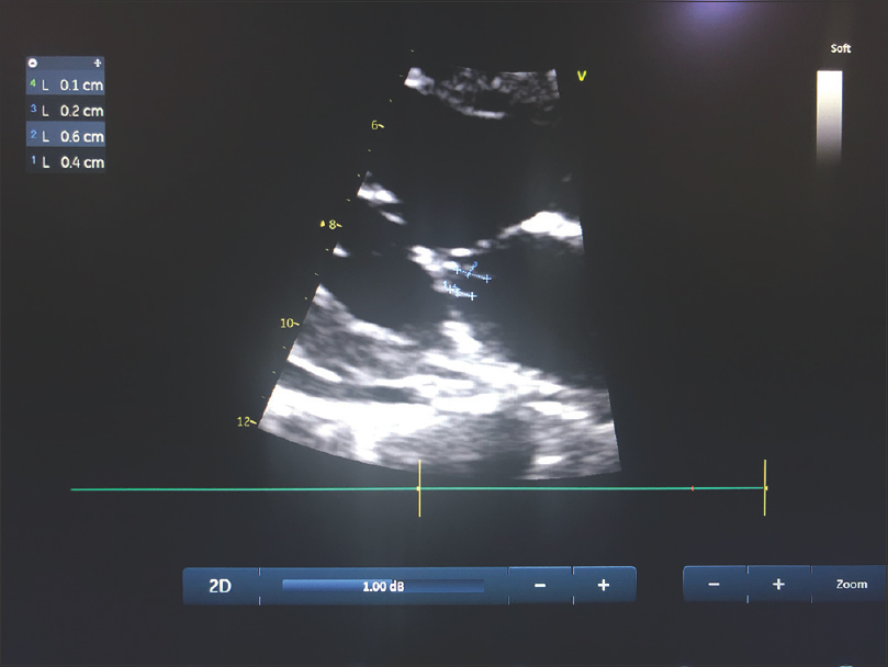 Transthoracic echocardiogram showing two vegetations attached to the atrial aspect of the posterior mitral leaflet measuring 4 × 1 mm and 6 × 2 mm