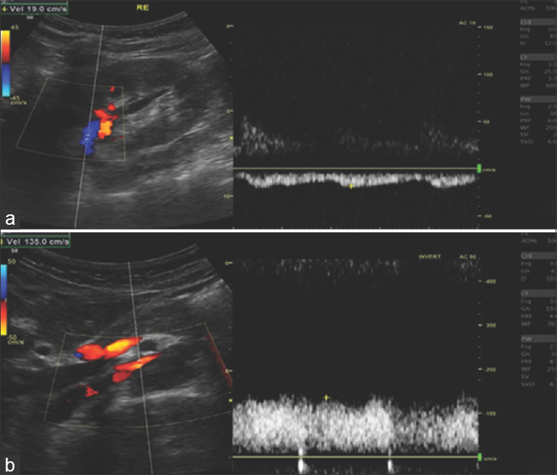 Doppler ultrasound. Peak systolic velocity ratios between hilar and mesoaortic segments of LRV. (a) Peak systolic velocity of hilar segment estimated in 19 cm/s; (b) peak systolic velocity of mesoaortic segment estimated in 135 cm/s. Ratio 7.1