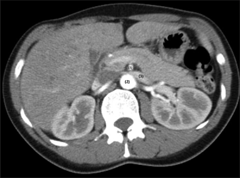 Computer tomography; axial plane. (1) SMA; (2) aorta; (3) LRV; there is a left renal vein compression between aorta and superior mesenteric