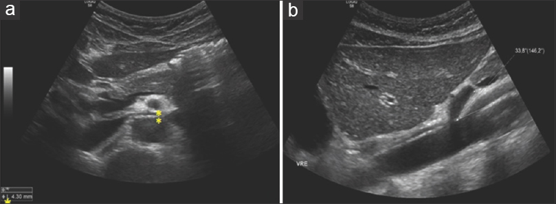 (a) Transversal scan. Distance between SMA (posterior wall) and aorta (anterior wall) measure approximately 4 mm (normal values are 5-6 mm). (b) Longitudinal scan. Acute angle origin of the SMA from the aorta (normal values reported as 54 degrees +/- 5 degrees