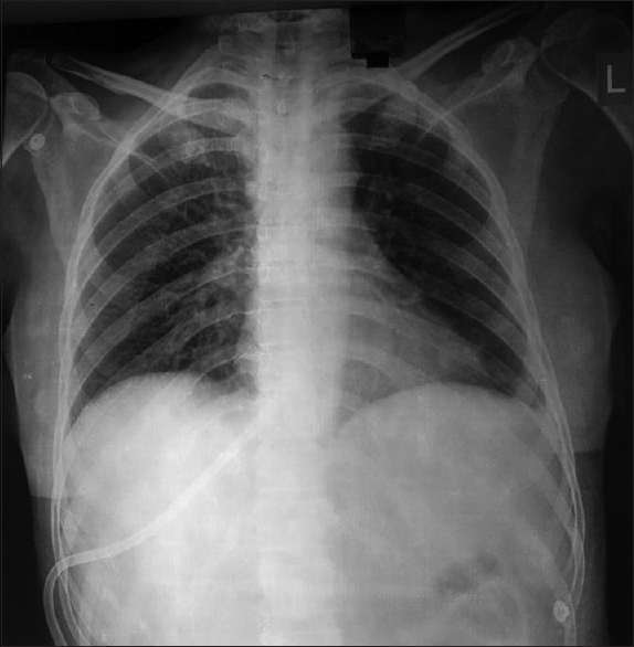 X-ray showing tip of hepatic vein permcath in IVC