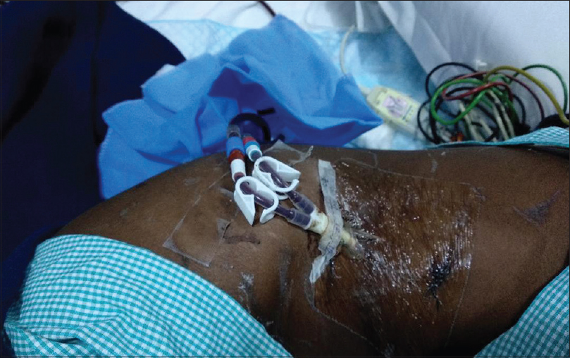 Patient showing entry point of hepatic vein permcath