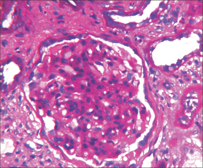 Glomeruli showing expansion of mesangial matrix with mild increase in mesangial cellularity. Interstitial inflammation seen [Periodic Acid Schiff stain, 40X].