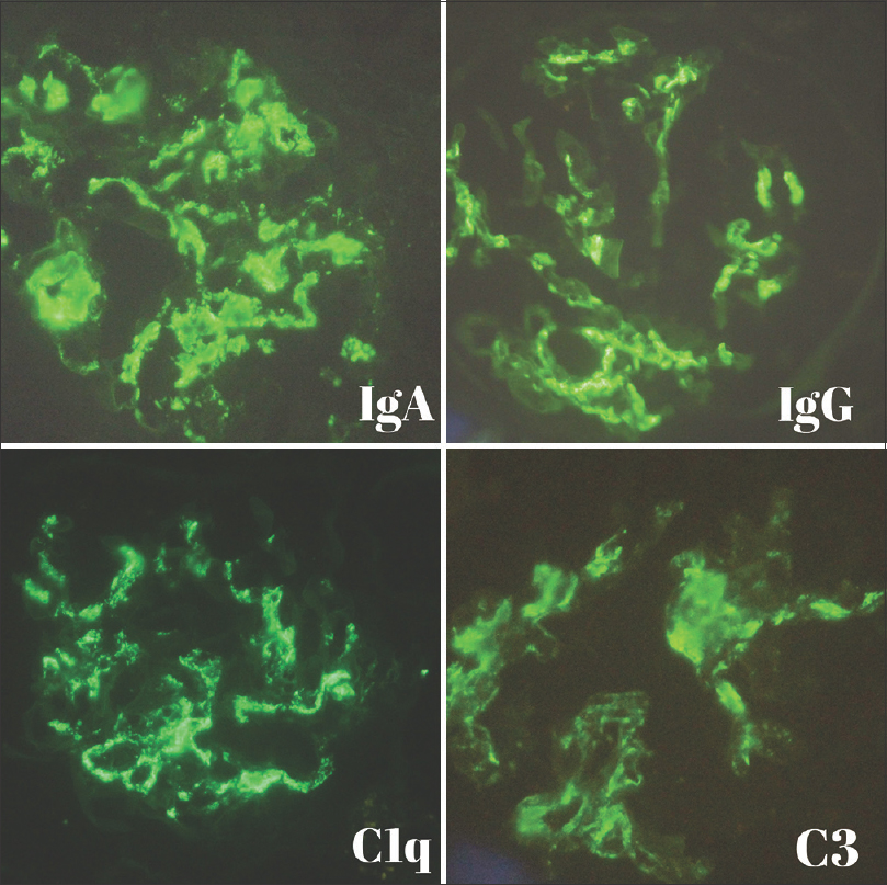 Direct immunofluorescence showing mesangial and peripheral capillary loops granular staining of IgA (3+), IgG (2+), C1q (2+), and C3 (3+)