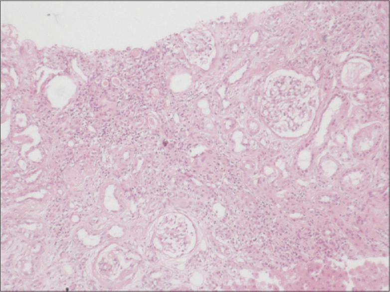 Post-mortem renal biopsy shows tubular atrophy with focal thyroidisation and severe interstitial fibrosis