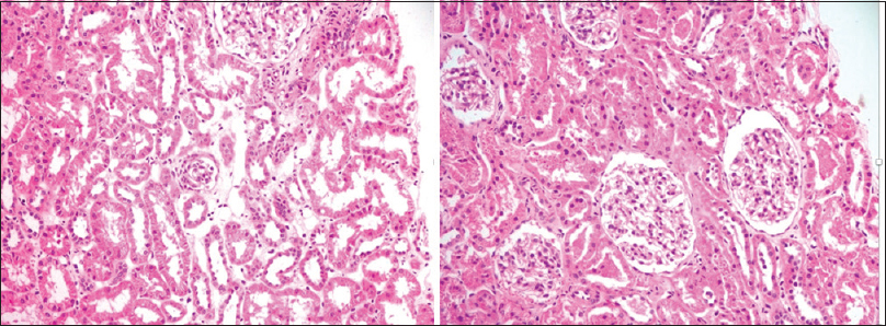 Renal biopsy showing tubules and glomerular changes suggestive of minimal change disease (hematoxylin-eosin stain, 20X)