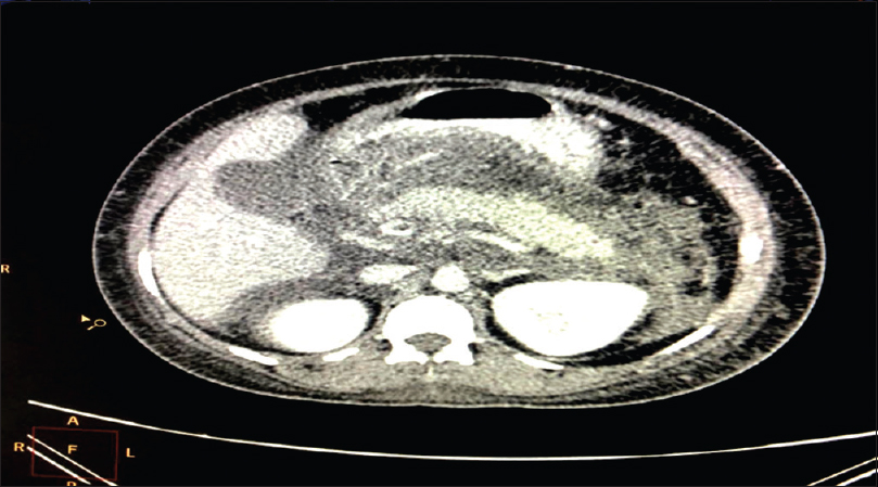 CT scan of abdomen of Case 2