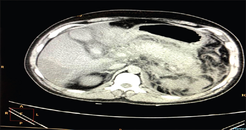 CT scan of abdomen of Case 3