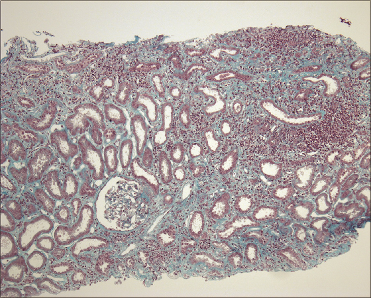 Interstitial lymphocytic infiltrate, with tubular epithelial dystrophy, without glomerular abnormality. (Masson trichrome, magnification ×100)