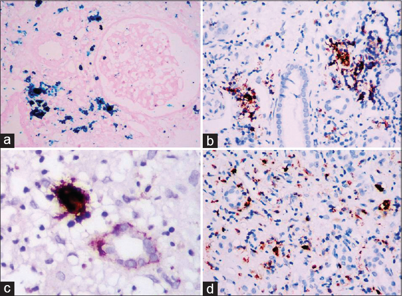 (a) Hemosiderin granules are highlighted by Perls Prussian blue stain (×200). (b) Erythroid cells are identified with glycophorin immunostain (×200). (c) CD61 immunostain highlights a megakaryocyte (×400). (d) Myeloperoxidase stain identifies myeloid cells (×200)