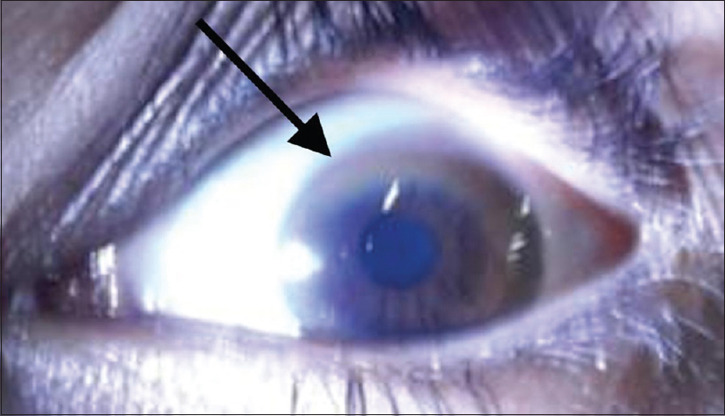 Kayser-Fleischer ring (K-F ring) (black arrow) due to copper deposition on Descemet membrane visible on physical examination