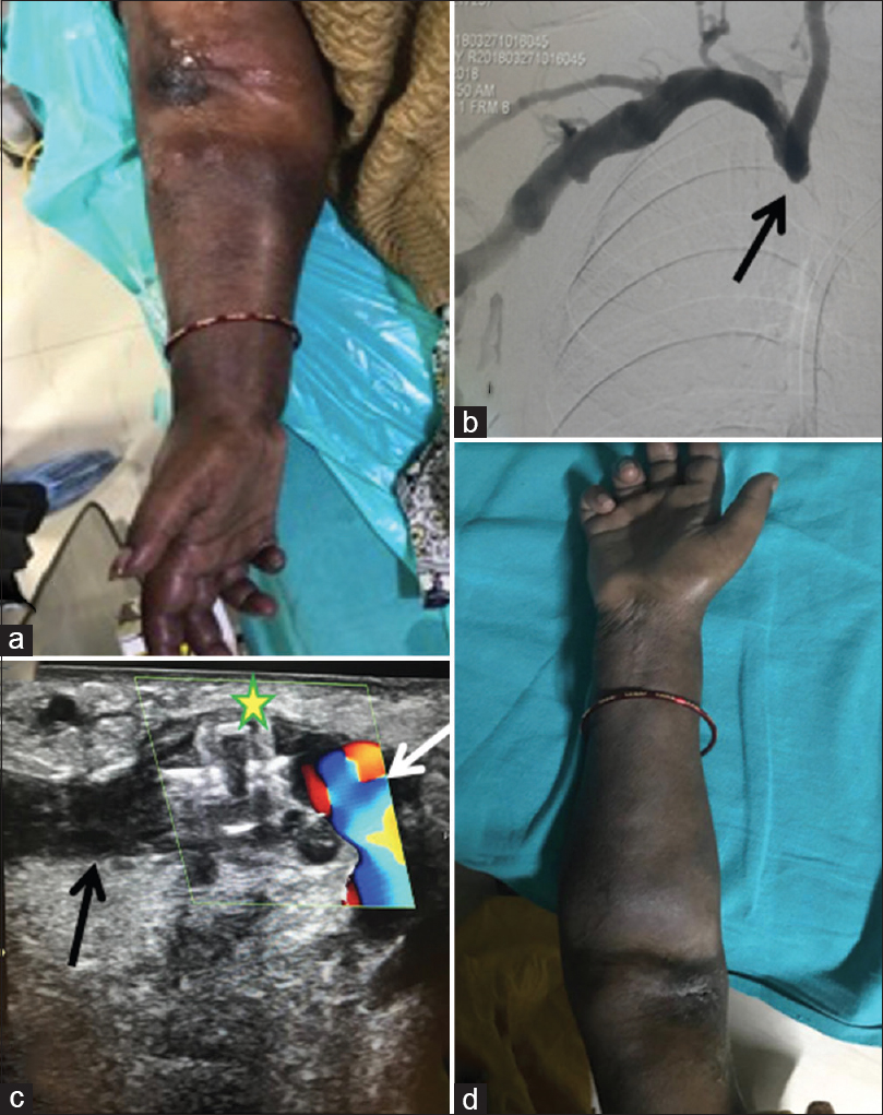 58-year-old female with right brachiocephalic AVF with intractable arm edema of the right arm (a), digital subtraction angiogram showing chronic occlusion of the right brachiocephalic vein (black arrow, b), USG image shows Amplatzer vascular plug (yellow star*) in situ with flow in brachial artery (white arrow) and no flow within the venous end (black arrow) of the AVF at the juxta-anastomotic site (c). A post procedure day 2 image of the right arm of patient showing resolution of the edema and clinical improvement (d)