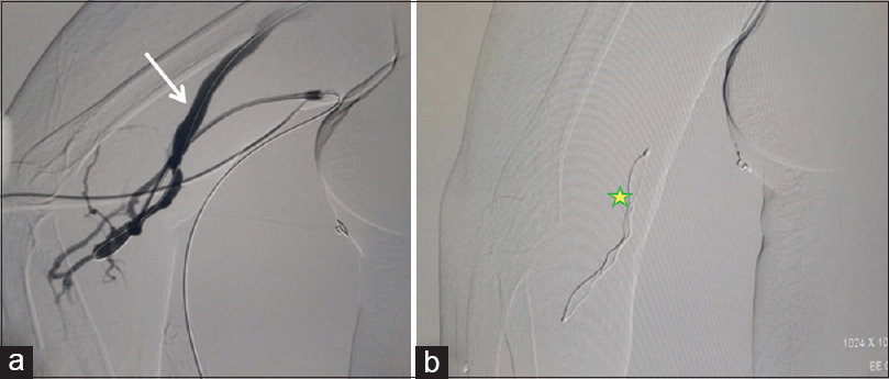 45-year-old female with right brachiocephalic fistula. Digital subtraction angiogram from the sheath placed at the juxta-anastomotic site shows filling of the cephalic vein (white arrow) (a), and deployment of the AVP plug (yellow star *) via sheath seen (b)