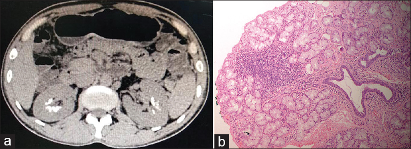 (a) CT of the abdomen showing bilateral medullary nephrocalcinosis (MNC) and (b) Lip biopsy showing multiple foci of lymphoid aggregates (50 cells/foci) in 2–3 lobules suggestive of Chisholm and Mason grade 4 Sjogren syndrome